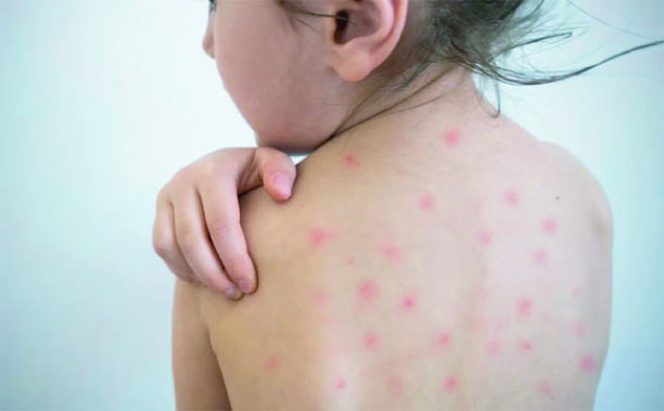 গত ২৪ ঘন্টায় হামের মৃত্যু ৪, আক্রান্ত ১,১৯৭